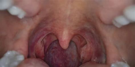 Experts Link Rising Throat Cancer Cases To Hpv Oral Sex