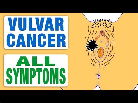 Vulvar Cancer Early Signs