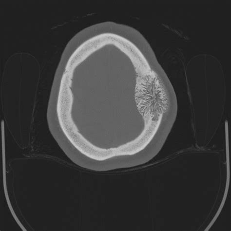 Skull Vault Hemangioma Image Radiopaedia Org