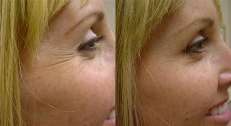 Botox Treatment For Crow S Feet Before And After Photo