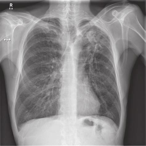 Varicose And Cystic Bronchiectasis With Mucus Plugging In Upper Lobes Download Scientific Diagram