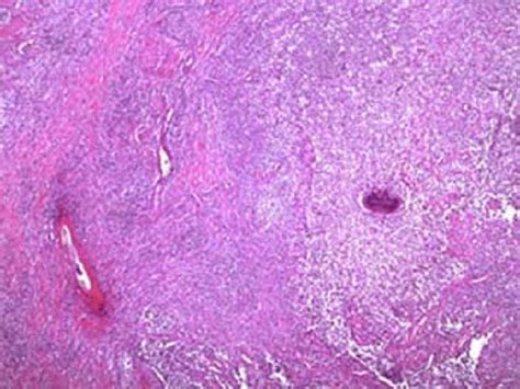 Figure 2 From Pilonidal Sinus Of The Glans Penis Associated With Actinomyces Case Reports And