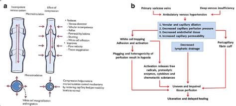 Venous Ulcer Pathophysiology