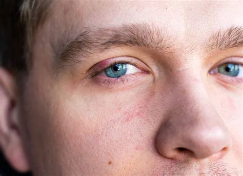 Selective Focus On Swollen And Painful Red Upper Eye Lid With Onset Of