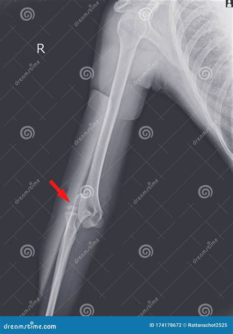 X-ray Elbow Dislocations and Fracture . Stock Photo - Image of health ...