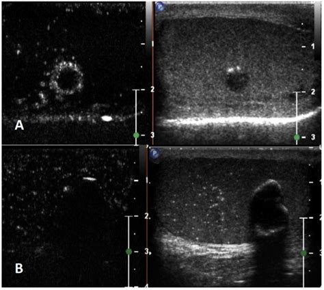 Multiparametric Ultrasound For Diagnosing Testicular Lesions