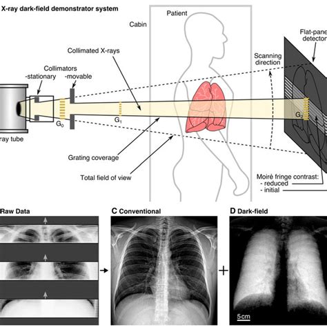 Pdf X Ray Dark Field Chest Imaging Can Detect And Quantify Emphysema