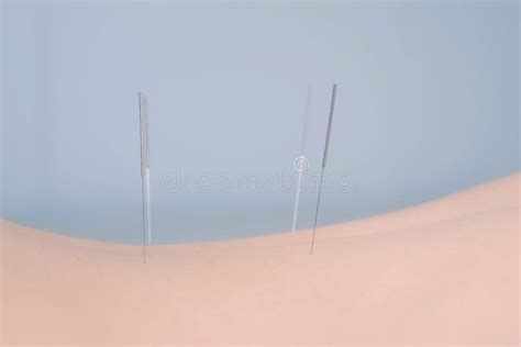 Woman on Acupuncture Treatment with Needles Inserted in Her Back, Side Iew. Stock Image - Image ...