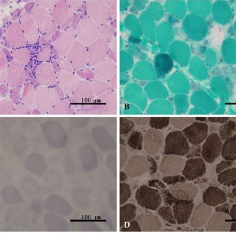 Muscle biopsy specimen. a The muscle biopsy specimen revealed many ...