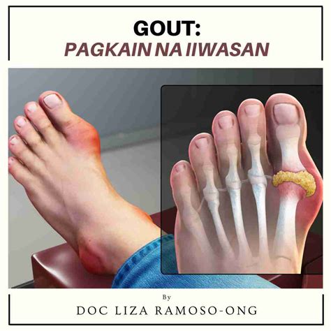 Arthritis Archives Doc Liza Ramoso Ong