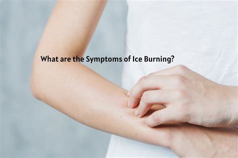 What Are The Symptoms Of Ice Burning