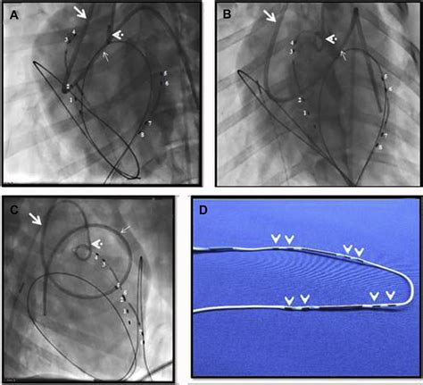 The Future Of Percutaneous Epicardial Interventions Cardiac