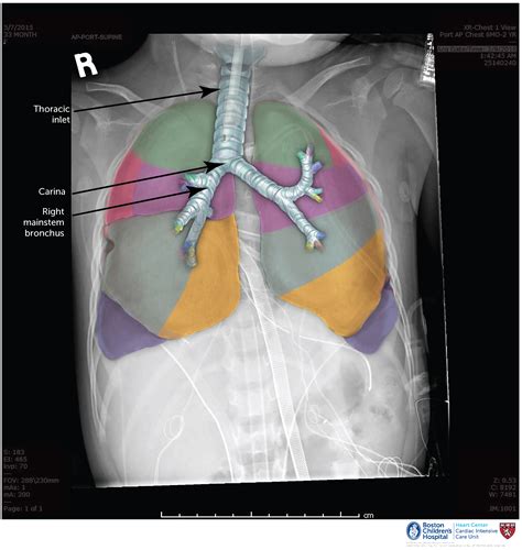 A Guide To Mobile Chest X Rays For Thoracic And Cardiac Off