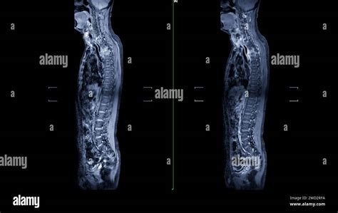 An Mri Of The Whole Spine Image Is A Comprehensive Visual