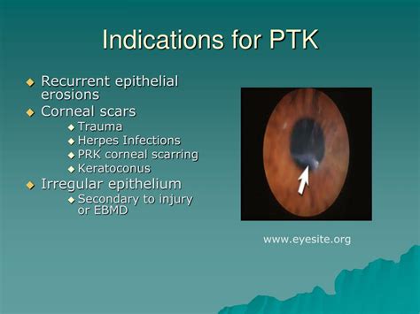 PPT - Phototherapeutic Keratectomy PowerPoint Presentation, free ...