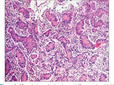 Figure 1 From Sertoliform Endometrioid Tumor Of Ovary Presenting As