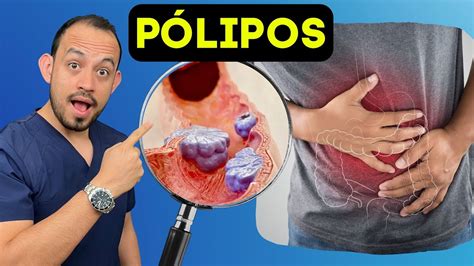 10 DATOS IMPORTANTES sobre Pólipos en el Colon Síntomas Causas