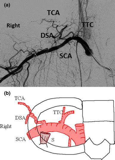 Right Subclavian Artery And Its Branches A Angiographic View The Download Scientific Diagram