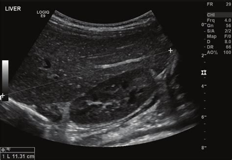 Abdominal ultrasound of the case. | Download Scientific Diagram