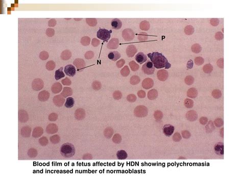 Ppt Hemolytic Disease Of Newborn Powerpoint Presentation Free