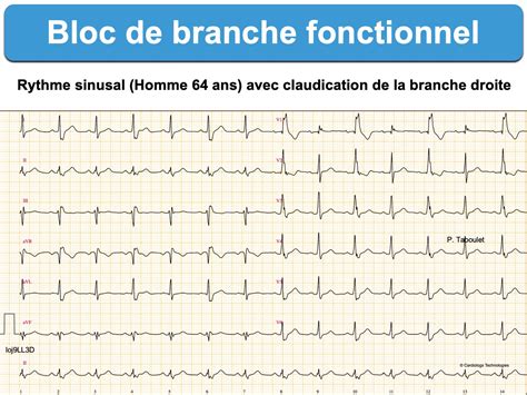 Bloc De Branche Fonctionnel E Cardiogram