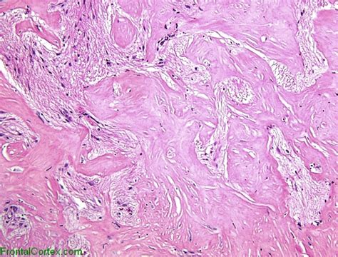 Sclerotic Meningioangiomatosis H E Stain X 100