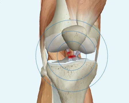 Cirug A Del Ligamento Cruzado Anterior Todo Lo Que Debes Saber