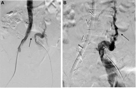 Intraprocedural Fluoroscopic Image Of Attempted Interventional