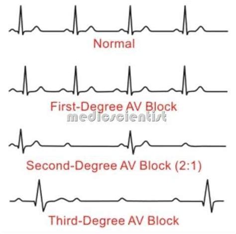 How To Treatment 3rd Degree Av Block