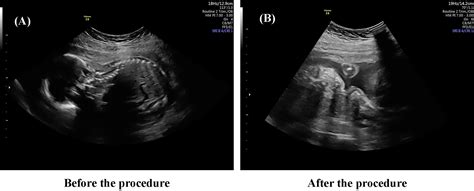 Amnioinfusion compared with expectant management in oligohydramnios ...