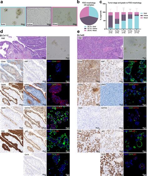 Bladder Cancer Blca Patient Derived Organoids Pdos Recapitulate