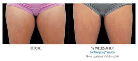 Coolsculpting® At Cosmetic Laser Centers In Pittsburgh