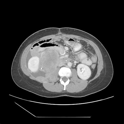 Liposarcoma Ct Wikidoc