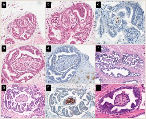 An Update On Atypical Large Glandular Proliferations Of The Prostate