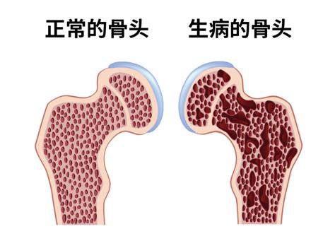 骨质疏松别只知道补钙！6 个真相现在知道还不晚丁香医生