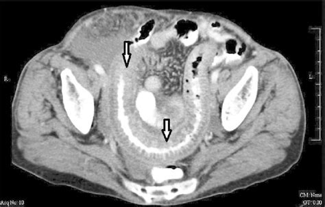 Double contrast CT scan of abdomen with arrows showing distal ileal... | Download Scientific Diagram