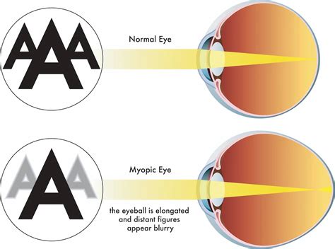 Presbyopia Treatment In Chicago Il Kraff Eye Institute