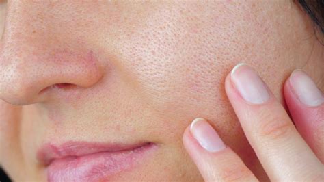 Enlarged Pores Treatment Laser Treatment For Pores Elc