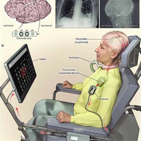 Pdf Fully Implanted Braincomputer Interface In A Locked In Patient