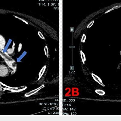 Computed Tomography Angiography Pulmonary Embolus Series Showing Saddle