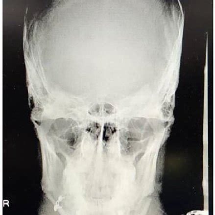 Post operative lateral ceph radiograph case 1. | Download Scientific Diagram