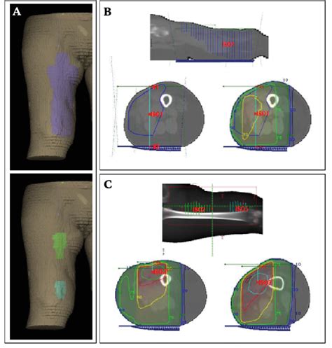 A D Reconstruction Of The Patient S Right Thigh Clinical Target