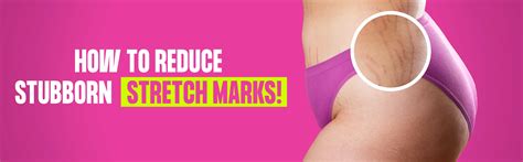 How To Reduce Stubborn Stretch Marks Vannabeltgelv