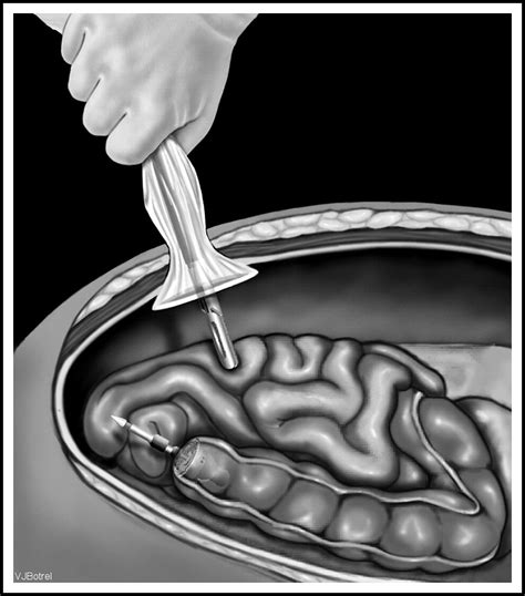 Rapidly Reversible Closure Of Mini Laparotomy During Laparoscopic