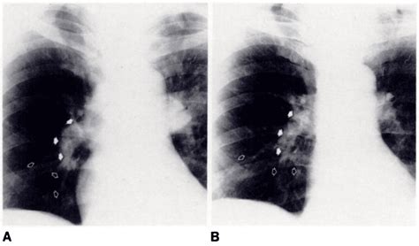 Palla sign • LITFL • Medical Eponym Library