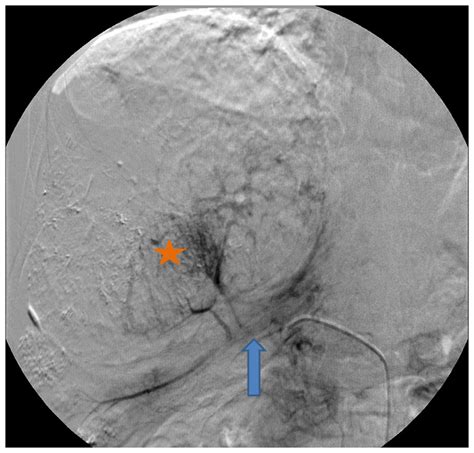 58 Year Old Male With Hepatocellular Carcinoma Treated With Tace To A