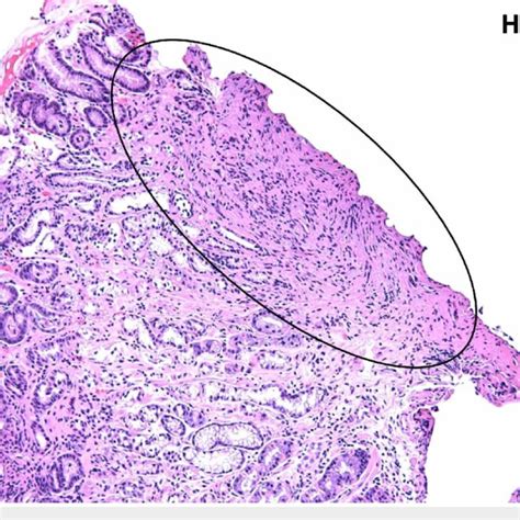 Postoperative Specimen Demonstrating Ectopic Pancreatic Tissue