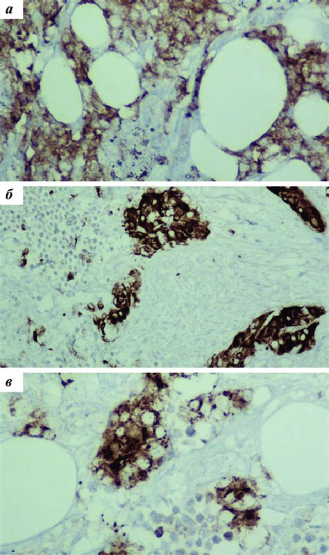 Immunohistochemical Analysis A Immunohistochemistry Showed Expression