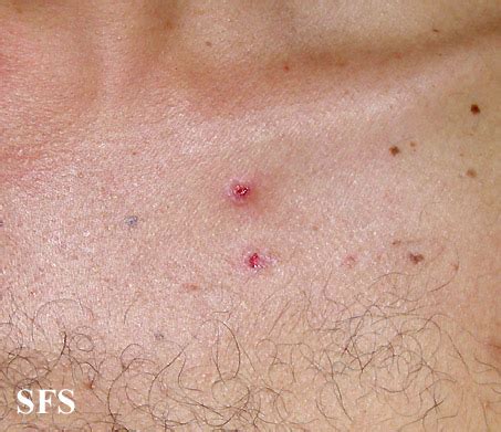 eosinophilic folliculitis - pictures, photos