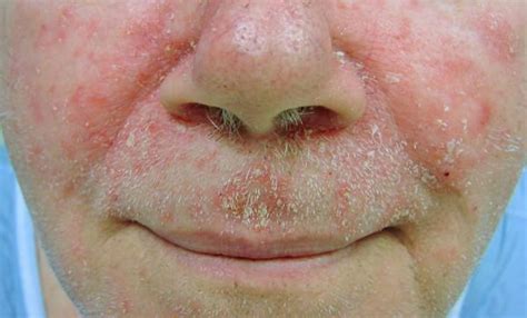 Pictures Of Seborrheic Dermatitis Symptoms And Pictures The Best Porn